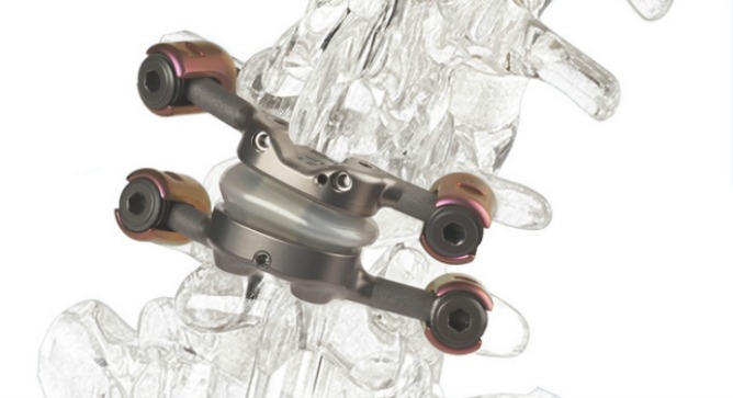 Instead of spinal fusion, the device allows for pain-free mobility.