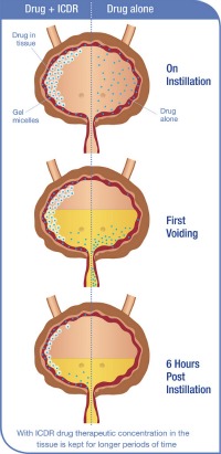Theracoat’s system makes drugs stick to the walls of the organ being treated.
