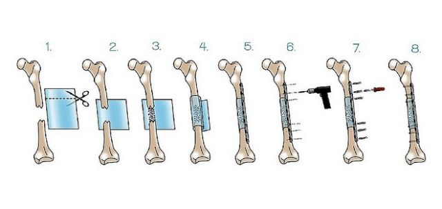 bonecure-regrowth Here is how BoneCure works.