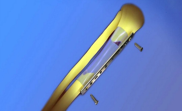 bonecure-sleeve The BoneCure sleeve.