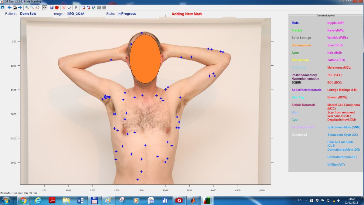 The DermaCompare system identifies and classifies moles and lesions. Image courtesy of Emerald Medical Applications