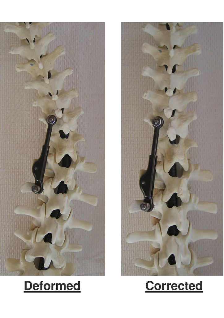 The ApiFix implant allows for incremental correction of the curvature by relaxing and realigning the ligaments and muscles surrounding the spinal column. Photo: courtesy 