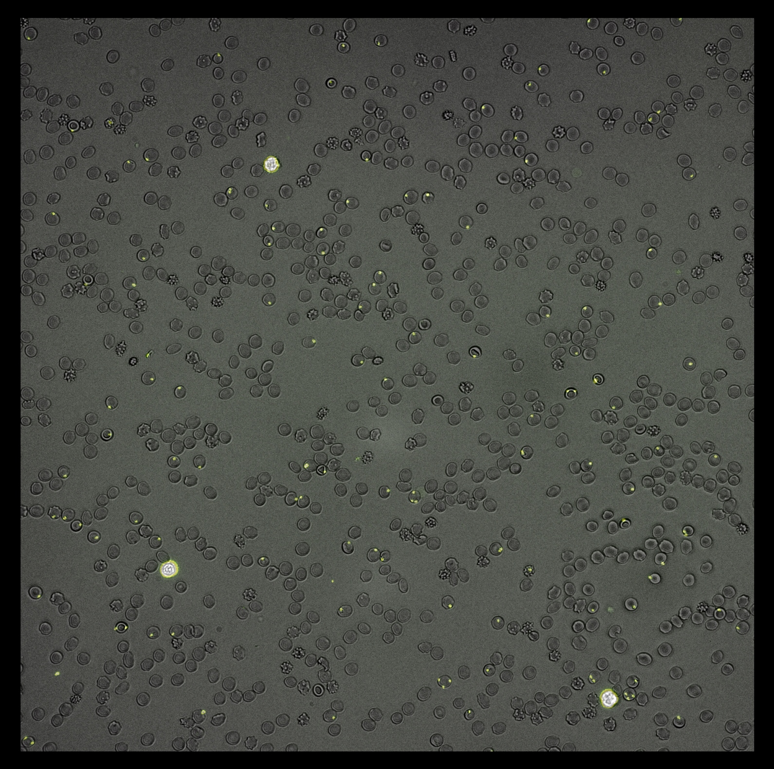 Image of blood sample infected with malaria scanned by the Parasight device. Photo: courtesy Image of blood sample infected with malaria scanned by the Parasight device. Photo: courtesy
