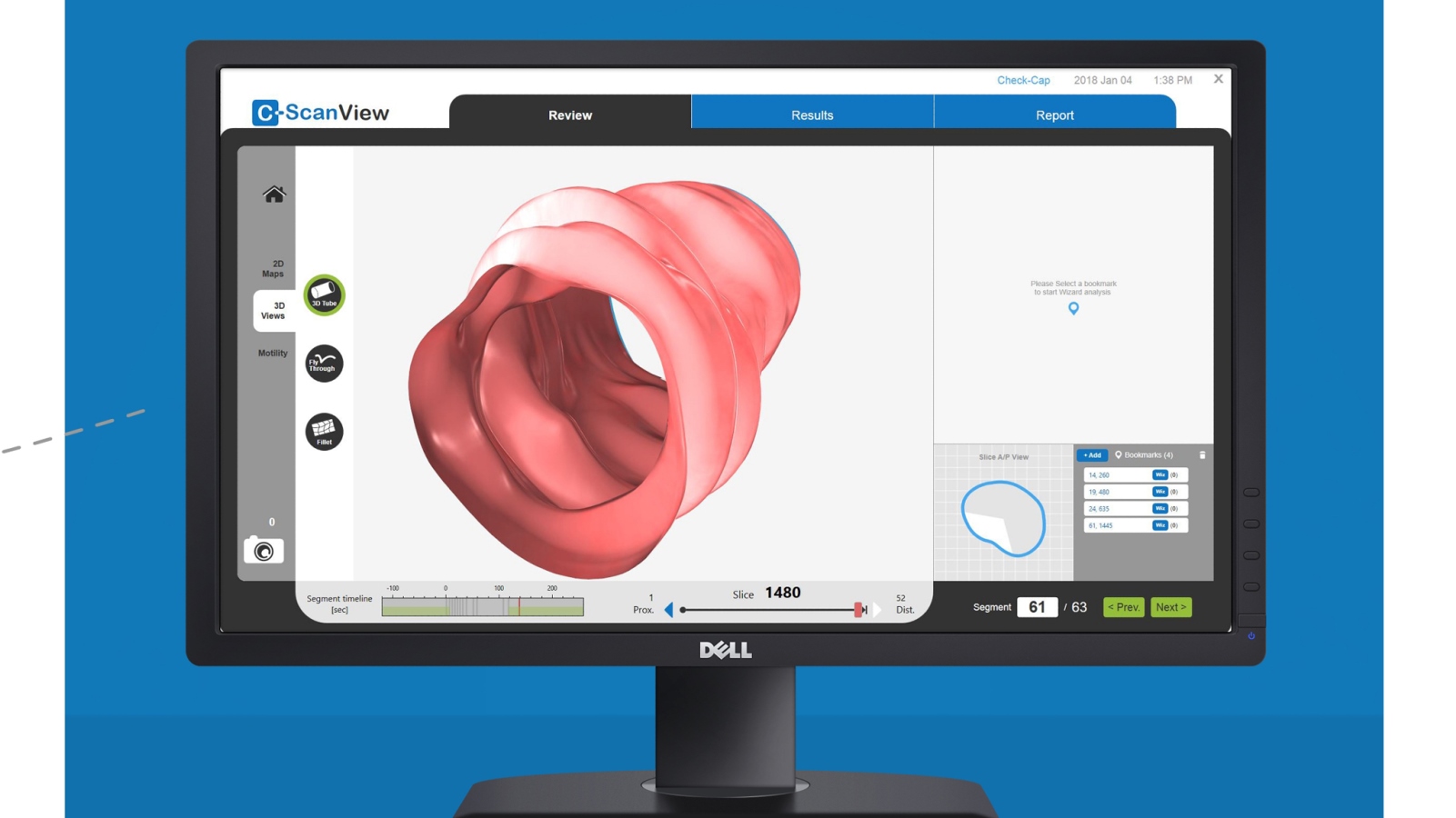 C-Scan View display and analysis for the physician. Photo: courtesy