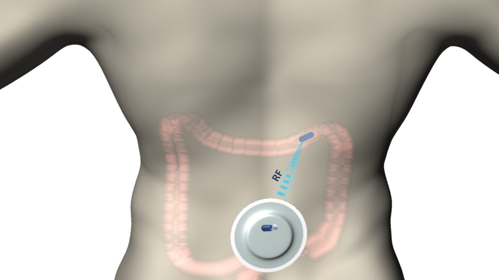 C-Scan’s recorder unit uses RF communication to control, track and receive data from the capsule. Photo courtesy of Check-Cap