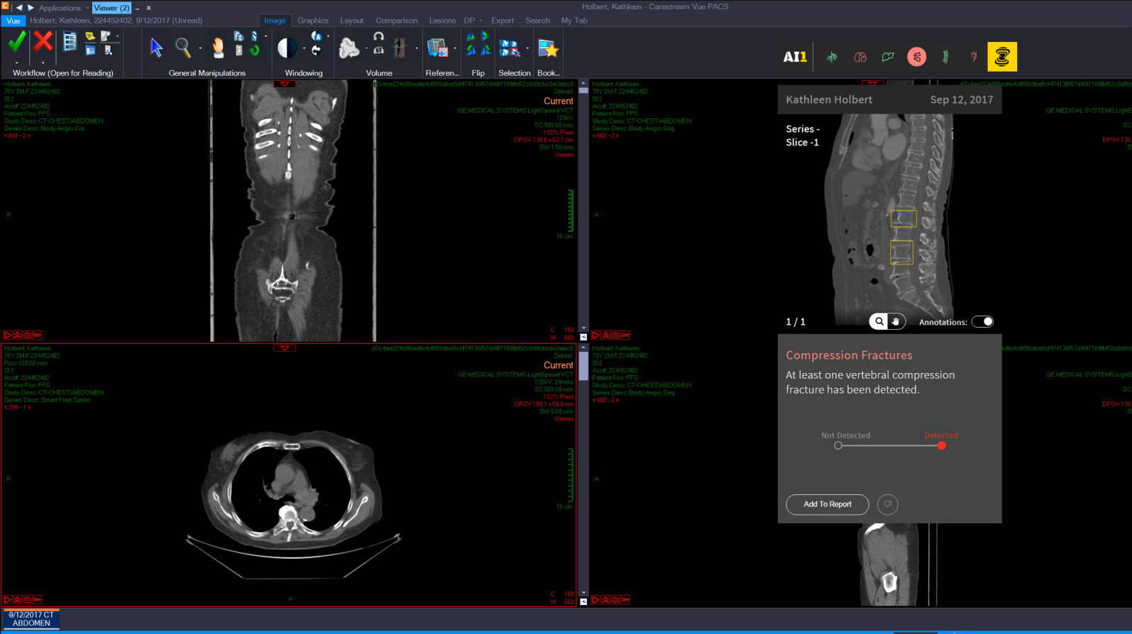 Image courtesy of Zebra Medical Vision