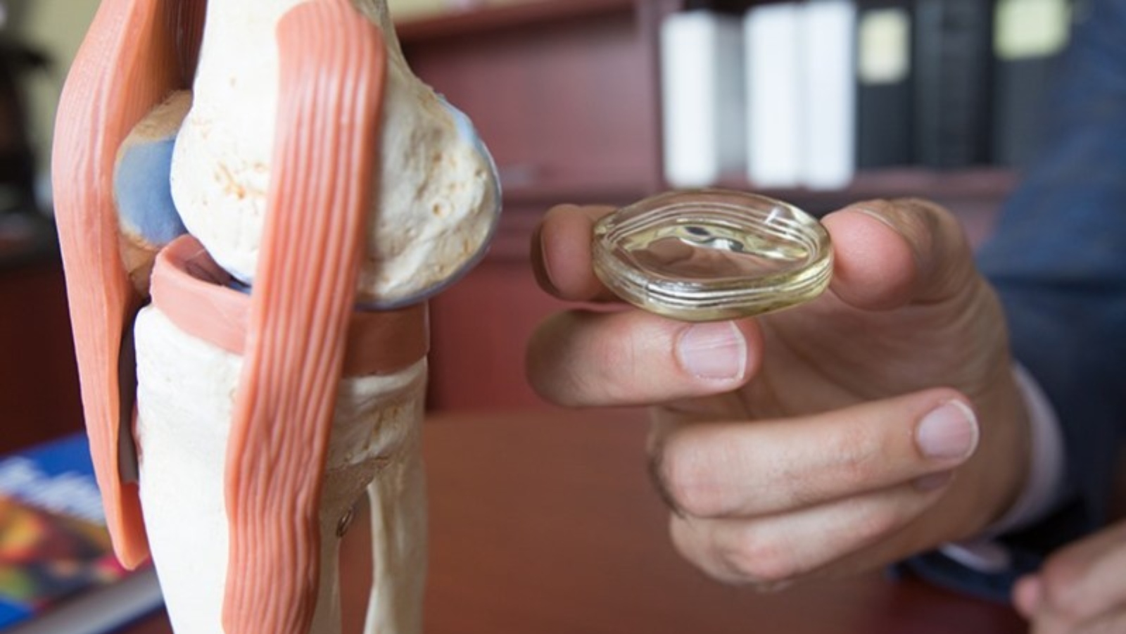 Active Implants’ NUsurface Meniscus Implant was developed in Israel. Photo: courtesy