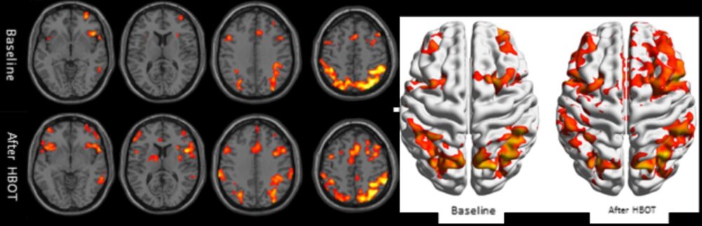 Clinical example of functional brain imaging by fMRI. The reduced brain activity in the frontal lobes (responsible for emotional regulation and executive functions) and in hippocampus (responsible for memory functions) is improved after hyperbaric oxygen therapy. Image courtesy of Tel Aviv University
