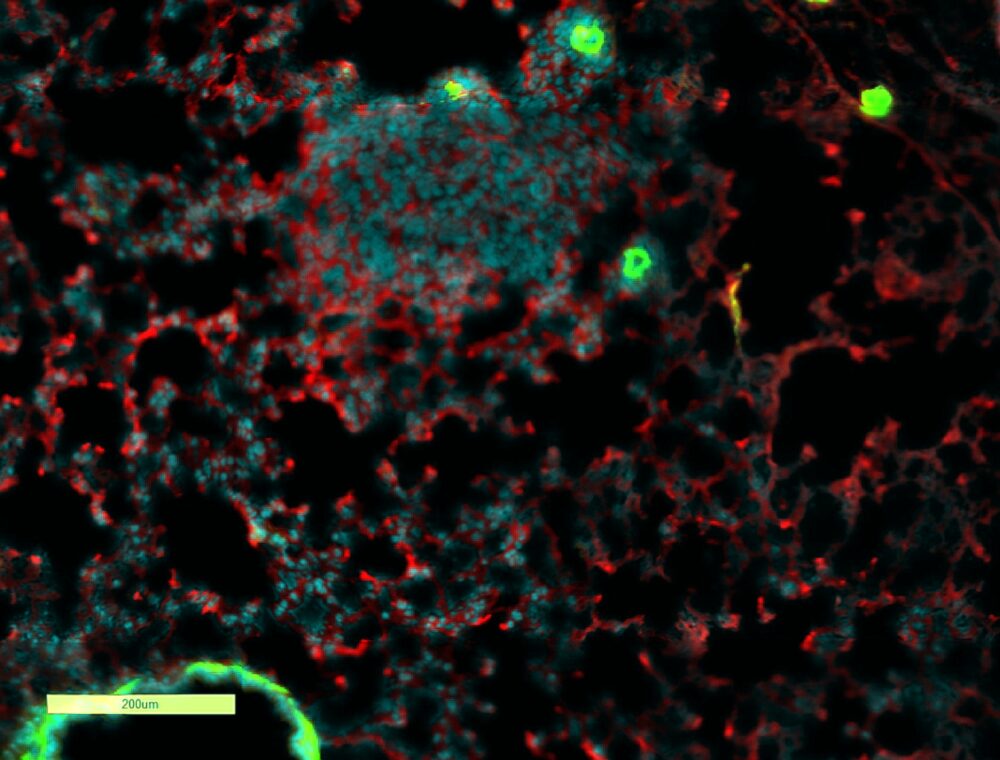 An image of lung with breast cancer metastasis, surrounded by inflammatory complement protein. Red: Complement protein; blue: cell nuclei; green: blood vessels. Photo by Lea Monteran