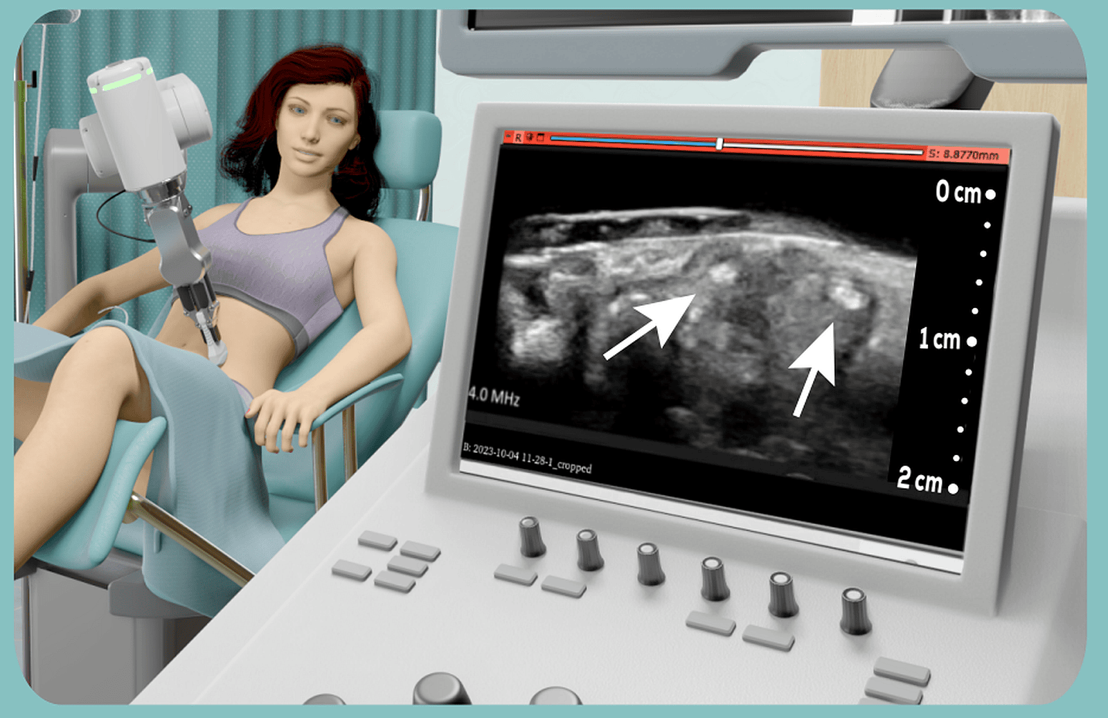 EndoCure is developing an ultrasound and AI system for diagnosing endometriosis. Image courtesy of EndoCure