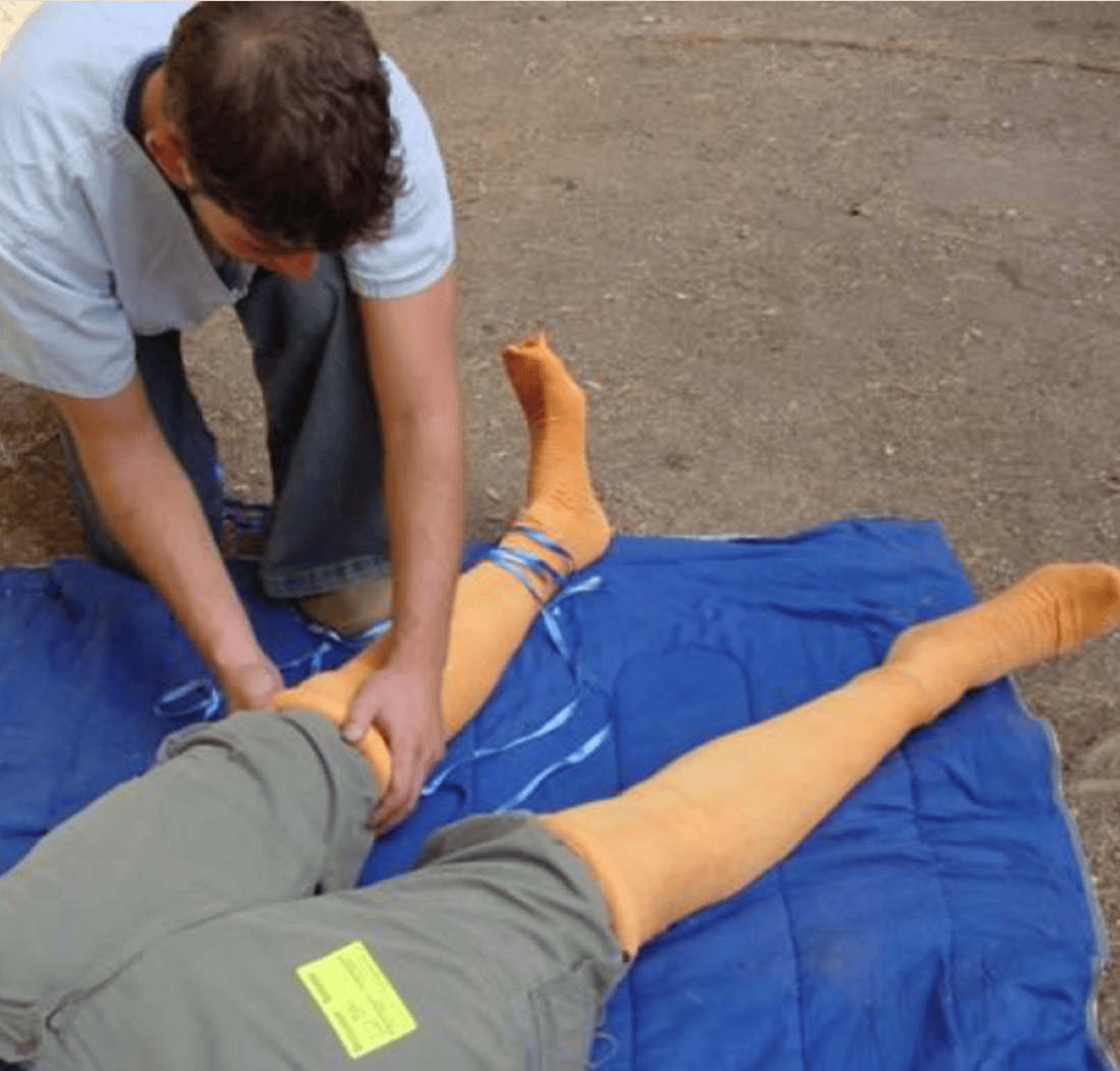 The HemaShock device is applied in emergency cases of dangerously low systolic blood pressure caused by hemorrhagic shock or cardiac arrest. Photo courtesy of OHK Medical